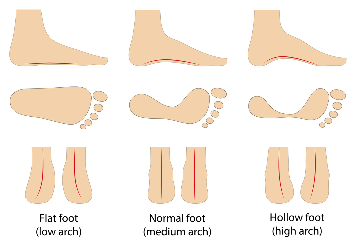 Flat foot and pes cavus