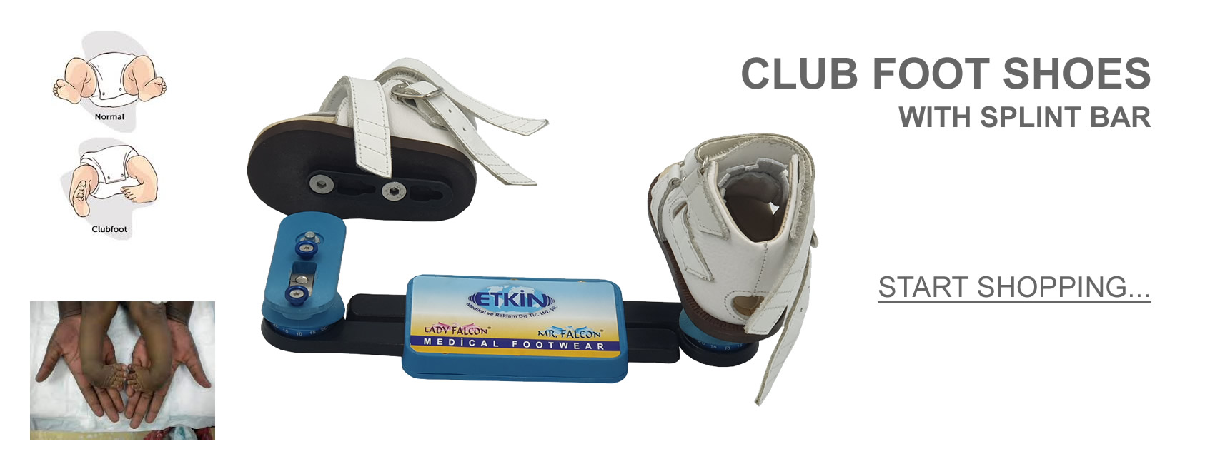 Club Foot