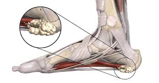 plantar fasciitis